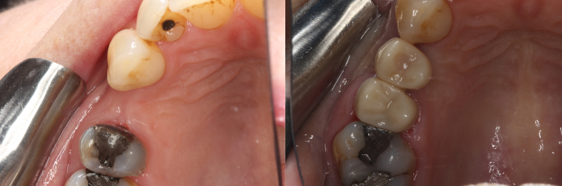 Dental Implant case 1