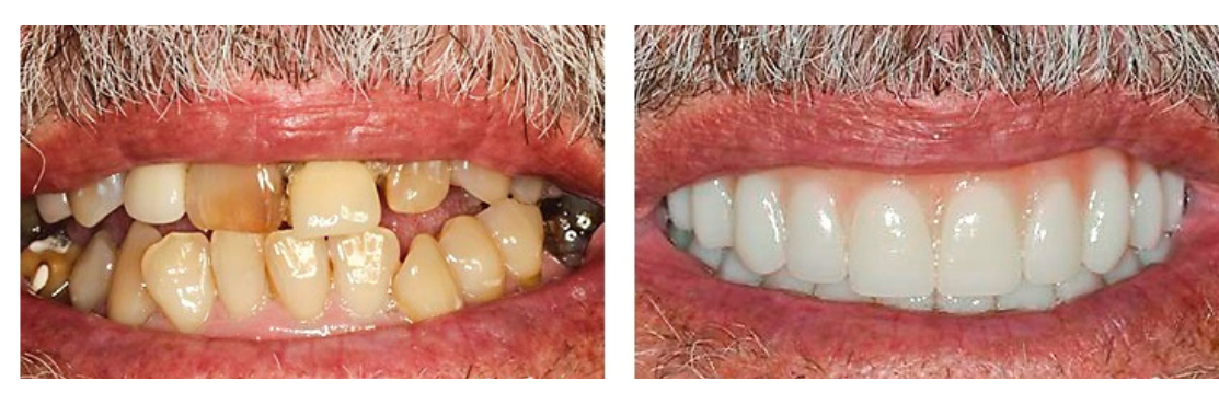 dental implants case 2(1)