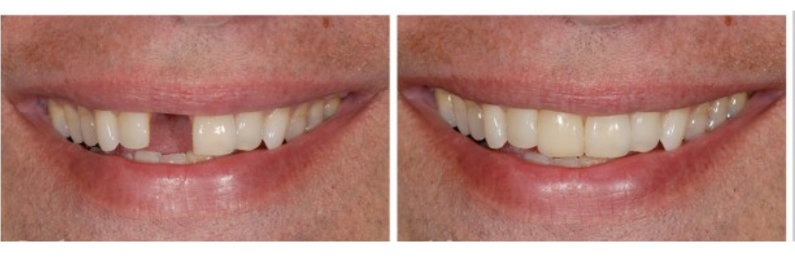 dental implants case 2(2)